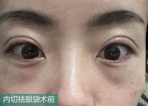 下眼袋黑|「眼袋」其實是眼周浮腫？專業醫師教你眼袋消除的6。